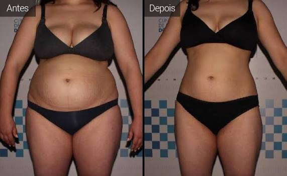 Antes e depois de Juliana R. após seguir o plano alimentar