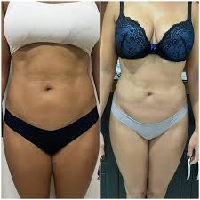 Antes e depois de Fernanda P. após seguir o plano alimentar