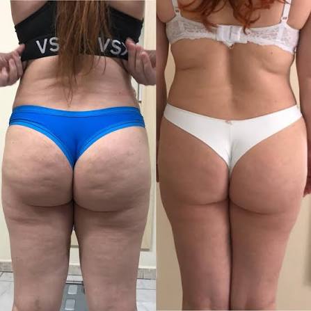 Antes e depois de Larissa T. após seguir o plano alimentar